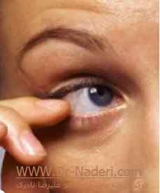 احساس جسم خارجی بعد از عمل لیزیک و لازک foreign body Sensation in the eye after LASIK surgery